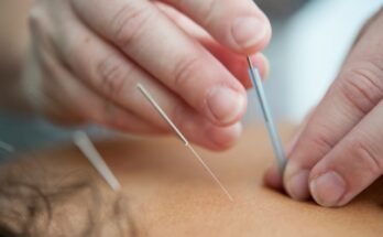 Acupuncture