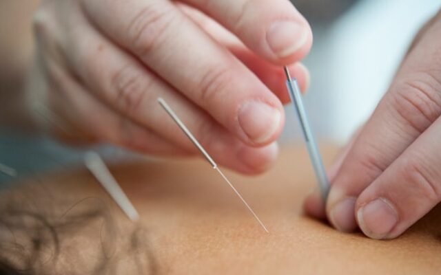 Acupuncture